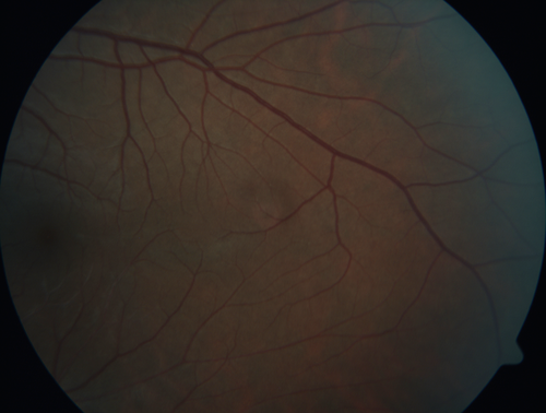 White Retinal Artiole Left eye - Inferotemporal
31 year old female with migraines and headaches for the last 12-13 years.  Sometimes she gets the visual symptoms with the migraine.  When she gets the migraines the pain is on the left side of her head.  She gets the problem a few times a month, sometimes more.  They usually last 5-6  hours. She has not had a permanent vision change.  When she gets a vision change there are spotty dots of blue neon lights in her vision.  With her glasses her two eyes are about the same.  VA 20/16 in Each Eye
