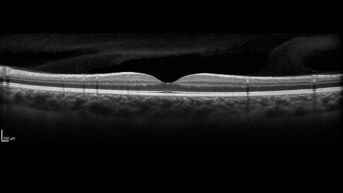 White Retinal Artiole Left eye - Inferotemporal
31 year old female with migraines and headaches for the last 12-13 years.  Sometimes she gets the visual symptoms with the migraine.  When she gets the migraines the pain is on the left side of her head.  She gets the problem a few times a month, sometimes more.  They usually last 5-6  hours. She has not had a permanent vision change.  When she gets a vision change there are spotty dots of blue neon lights in her vision.  With her glasses her two eyes are about the same.  VA 20/16 in Each Eye
