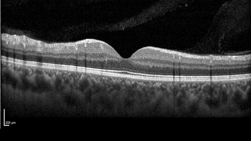 White Retinal Artiole Left eye - Inferotemporal
31 year old female with migraines and headaches for the last 12-13 years.  Sometimes she gets the visual symptoms with the migraine.  When she gets the migraines the pain is on the left side of her head.  She gets the problem a few times a month, sometimes more.  They usually last 5-6  hours. She has not had a permanent vision change.  When she gets a vision change there are spotty dots of blue neon lights in her vision.  With her glasses her two eyes are about the same.  VA 20/16 in Each Eye
