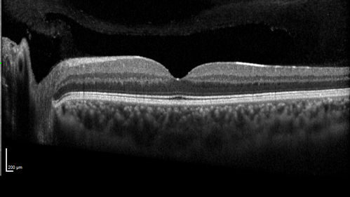 White Retinal Artiole Left eye - Inferotemporal
31 year old female with migraines and headaches for the last 12-13 years.  Sometimes she gets the visual symptoms with the migraine.  When she gets the migraines the pain is on the left side of her head.  She gets the problem a few times a month, sometimes more.  They usually last 5-6  hours. She has not had a permanent vision change.  When she gets a vision change there are spotty dots of blue neon lights in her vision.  With her glasses her two eyes are about the same.  VA 20/16 in Each Eye
