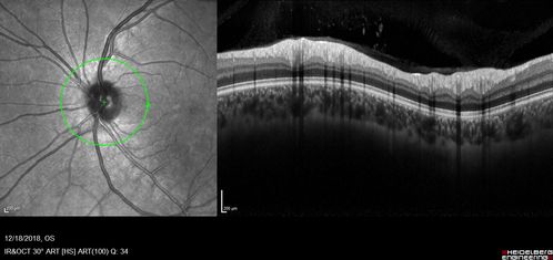 White Retinal Artiole Left eye - Inferotemporal
31 year old female with migraines and headaches for the last 12-13 years.  Sometimes she gets the visual symptoms with the migraine.  When she gets the migraines the pain is on the left side of her head.  She gets the problem a few times a month, sometimes more.  They usually last 5-6  hours. She has not had a permanent vision change.  When she gets a vision change there are spotty dots of blue neon lights in her vision.  With her glasses her two eyes are about the same.  VA 20/16 in Each Eye
