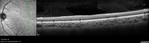 White Retinal Artiole Left eye - Inferotemporal
31 year old female with migraines and headaches for the last 12-13 years.  Sometimes she gets the visual symptoms with the migraine.  When she gets the migraines the pain is on the left side of her head.  She gets the problem a few times a month, sometimes more.  They usually last 5-6  hours. She has not had a permanent vision change.  When she gets a vision change there are spotty dots of blue neon lights in her vision.  With her glasses her two eyes are about the same.  VA 20/16 in Each Eye
