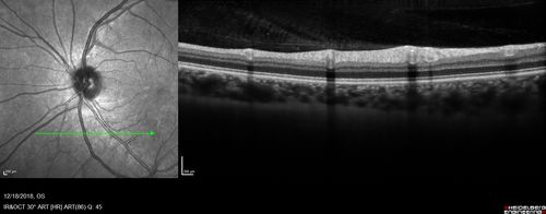 White Retinal Artiole Left eye - Inferotemporal
31 year old female with migraines and headaches for the last 12-13 years.  Sometimes she gets the visual symptoms with the migraine.  When she gets the migraines the pain is on the left side of her head.  She gets the problem a few times a month, sometimes more.  They usually last 5-6  hours. She has not had a permanent vision change.  When she gets a vision change there are spotty dots of blue neon lights in her vision.  With her glasses her two eyes are about the same.  VA 20/16 in Each Eye
