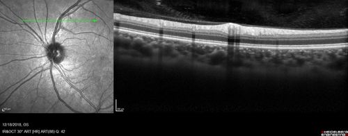 White Retinal Artiole Left eye - Inferotemporal
31 year old female with migraines and headaches for the last 12-13 years.  Sometimes she gets the visual symptoms with the migraine.  When she gets the migraines the pain is on the left side of her head.  She gets the problem a few times a month, sometimes more.  They usually last 5-6  hours. She has not had a permanent vision change.  When she gets a vision change there are spotty dots of blue neon lights in her vision.  With her glasses her two eyes are about the same.  VA 20/16 in Each Eye
