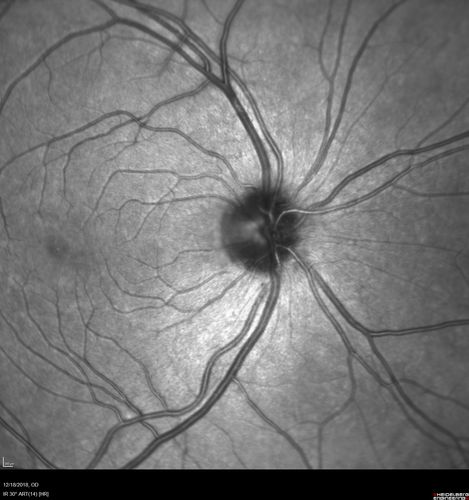White Retinal Artiole Left eye - Inferotemporal
31 year old female with migraines and headaches for the last 12-13 years.  Sometimes she gets the visual symptoms with the migraine.  When she gets the migraines the pain is on the left side of her head.  She gets the problem a few times a month, sometimes more.  They usually last 5-6  hours. She has not had a permanent vision change.  When she gets a vision change there are spotty dots of blue neon lights in her vision.  With her glasses her two eyes are about the same.  VA 20/16 in Each Eye
