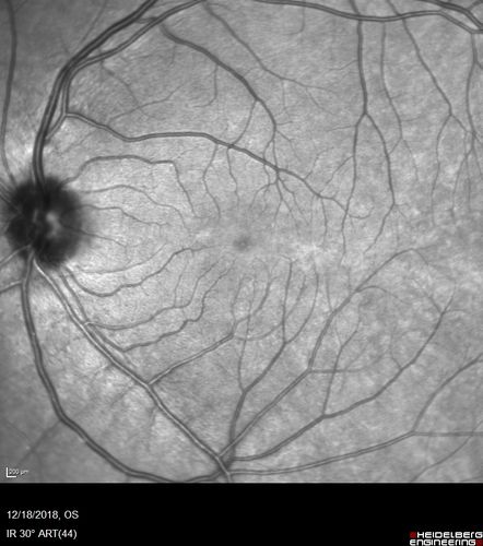 White Retinal Artiole Left eye - Inferotemporal
31 year old female with migraines and headaches for the last 12-13 years.  Sometimes she gets the visual symptoms with the migraine.  When she gets the migraines the pain is on the left side of her head.  She gets the problem a few times a month, sometimes more.  They usually last 5-6  hours. She has not had a permanent vision change.  When she gets a vision change there are spotty dots of blue neon lights in her vision.  With her glasses her two eyes are about the same.  VA 20/16 in Each Eye
