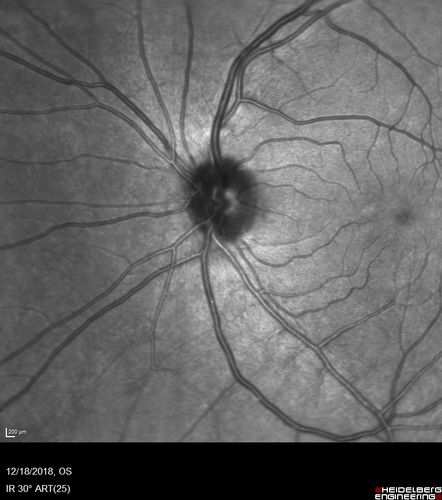 White Retinal Artiole Left eye - Inferotemporal
31 year old female with migraines and headaches for the last 12-13 years.  Sometimes she gets the visual symptoms with the migraine.  When she gets the migraines the pain is on the left side of her head.  She gets the problem a few times a month, sometimes more.  They usually last 5-6  hours. She has not had a permanent vision change.  When she gets a vision change there are spotty dots of blue neon lights in her vision.  With her glasses her two eyes are about the same.  VA 20/16 in Each Eye
