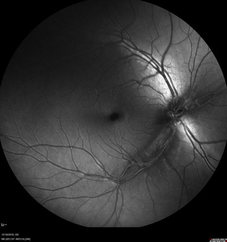 White Retinal Artiole Left eye - Inferotemporal
31 year old female with migraines and headaches for the last 12-13 years.  Sometimes she gets the visual symptoms with the migraine.  When she gets the migraines the pain is on the left side of her head.  She gets the problem a few times a month, sometimes more.  They usually last 5-6  hours. She has not had a permanent vision change.  When she gets a vision change there are spotty dots of blue neon lights in her vision.  With her glasses her two eyes are about the same.  VA 20/16 in Each Eye
