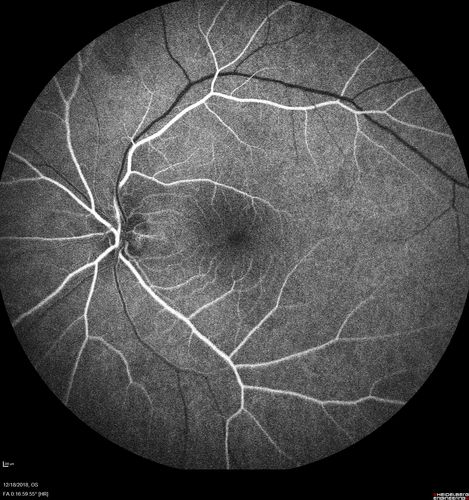 White Retinal Artiole Left eye - Inferotemporal
31 year old female with migraines and headaches for the last 12-13 years.  Sometimes she gets the visual symptoms with the migraine.  When she gets the migraines the pain is on the left side of her head.  She gets the problem a few times a month, sometimes more.  They usually last 5-6  hours. She has not had a permanent vision change.  When she gets a vision change there are spotty dots of blue neon lights in her vision.  With her glasses her two eyes are about the same.  VA 20/16 in Each Eye
