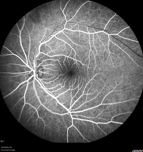 White Retinal Artiole Left eye - Inferotemporal
31 year old female with migraines and headaches for the last 12-13 years.  Sometimes she gets the visual symptoms with the migraine.  When she gets the migraines the pain is on the left side of her head.  She gets the problem a few times a month, sometimes more.  They usually last 5-6  hours. She has not had a permanent vision change.  When she gets a vision change there are spotty dots of blue neon lights in her vision.  With her glasses her two eyes are about the same.  VA 20/16 in Each Eye
