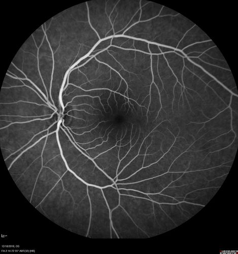 White Retinal Artiole Left eye - Inferotemporal
31 year old female with migraines and headaches for the last 12-13 years.  Sometimes she gets the visual symptoms with the migraine.  When she gets the migraines the pain is on the left side of her head.  She gets the problem a few times a month, sometimes more.  They usually last 5-6  hours. She has not had a permanent vision change.  When she gets a vision change there are spotty dots of blue neon lights in her vision.  With her glasses her two eyes are about the same.  VA 20/16 in Each Eye
