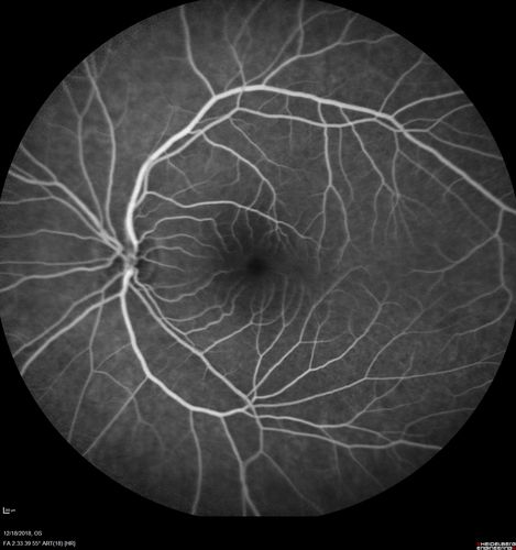 White Retinal Artiole Left eye - Inferotemporal
31 year old female with migraines and headaches for the last 12-13 years.  Sometimes she gets the visual symptoms with the migraine.  When she gets the migraines the pain is on the left side of her head.  She gets the problem a few times a month, sometimes more.  They usually last 5-6  hours. She has not had a permanent vision change.  When she gets a vision change there are spotty dots of blue neon lights in her vision.  With her glasses her two eyes are about the same.  VA 20/16 in Each Eye
