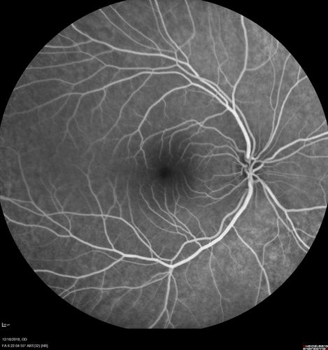 White Retinal Artiole Left eye - Inferotemporal
31 year old female with migraines and headaches for the last 12-13 years.  Sometimes she gets the visual symptoms with the migraine.  When she gets the migraines the pain is on the left side of her head.  She gets the problem a few times a month, sometimes more.  They usually last 5-6  hours. She has not had a permanent vision change.  When she gets a vision change there are spotty dots of blue neon lights in her vision.  With her glasses her two eyes are about the same.  VA 20/16 in Each Eye
