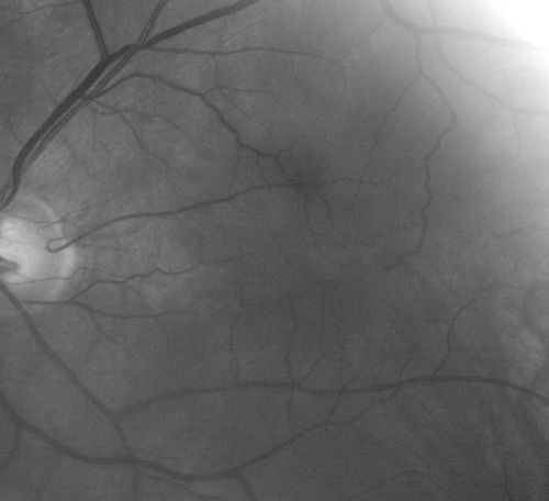 Albinism and Foveal Hypoplasia
65-year-old man was told about twenty years ago by a retina specialist that he spent so much time in the sun that he burned out his maculae.  He does have two brothers who have dark brown hair and he has always had white hair.  He had eye exercises when he was eight or nine because of a lazy eye and his brothers, when he was little, used to call him an albino.  He has been diagnosed by dermatologists as having possible albinism but he has been told by other people his skin is just fair.  

VA 20/70  OU
Keywords: foveal hypoplasia;albinism