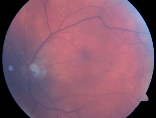 Albinism and Foveal Hypoplasia
65-year-old man was told about twenty years ago by a retina specialist that he spent so much time in the sun that he burned out his maculae.  He does have two brothers who have dark brown hair and he has always had white hair.  He had eye exercises when he was eight or nine because of a lazy eye and his brothers, when he was little, used to call him an albino.  He has been diagnosed by dermatologists as having possible albinism but he has been told by other people his skin is just fair.  

VA 20/70  OU
Keywords: foveal hypoplasia;albinism