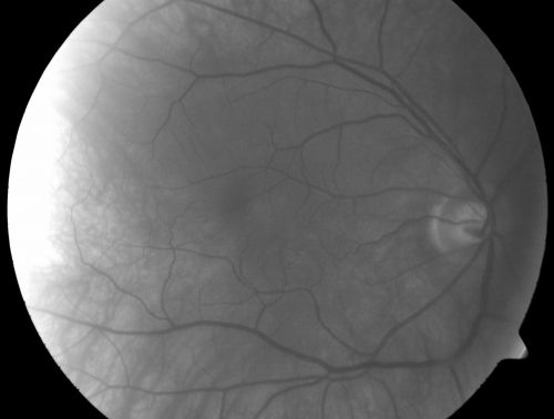 Albinism and Foveal Hypoplasia
65-year-old man was told about twenty years ago by a retina specialist that he spent so much time in the sun that he burned out his maculae.  He does have two brothers who have dark brown hair and he has always had white hair.  He had eye exercises when he was eight or nine because of a lazy eye and his brothers, when he was little, used to call him an albino.  He has been diagnosed by dermatologists as having possible albinism but he has been told by other people his skin is just fair.  

VA 20/70  OU
Keywords: foveal hypoplasia;albinism