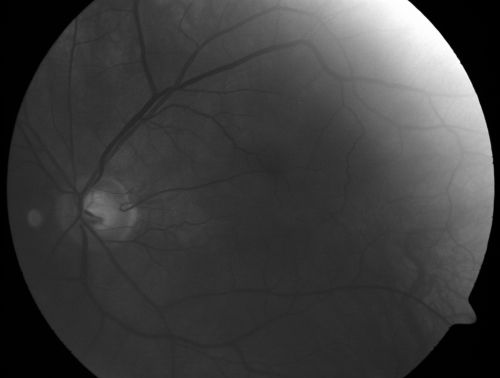 Albinism and Foveal Hypoplasia
65-year-old man was told about twenty years ago by a retina specialist that he spent so much time in the sun that he burned out his maculae.  He does have two brothers who have dark brown hair and he has always had white hair.  He had eye exercises when he was eight or nine because of a lazy eye and his brothers, when he was little, used to call him an albino.  He has been diagnosed by dermatologists as having possible albinism but he has been told by other people his skin is just fair.  

VA 20/70  OU
Keywords: foveal hypoplasia;albinism