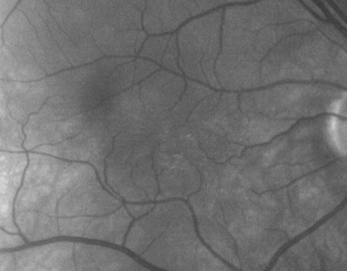Albinism and Foveal Hypoplasia
65-year-old man was told about twenty years ago by a retina specialist that he spent so much time in the sun that he burned out his maculae.  He does have two brothers who have dark brown hair and he has always had white hair.  He had eye exercises when he was eight or nine because of a lazy eye and his brothers, when he was little, used to call him an albino.  He has been diagnosed by dermatologists as having possible albinism but he has been told by other people his skin is just fair.  

VA 20/70  OU
Keywords: foveal hypoplasia;albinism