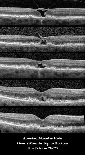 Aborted Macular Hole
73 year old female with vision improved from 20/60 to 20/20 over 8 months 
