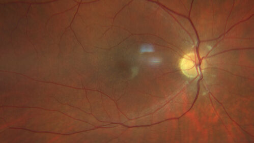 Achromatopsia
28 year old female Good vision since birth started wearing glasses at 2, denies trauma. She does have congenital nystagmus.

VA OD: Dcc20/200-2 PH20/200 NccJ7
VA OS: Dcc20/160 PHNI NccJ7
IOP: TP: OD:15 OS:12
