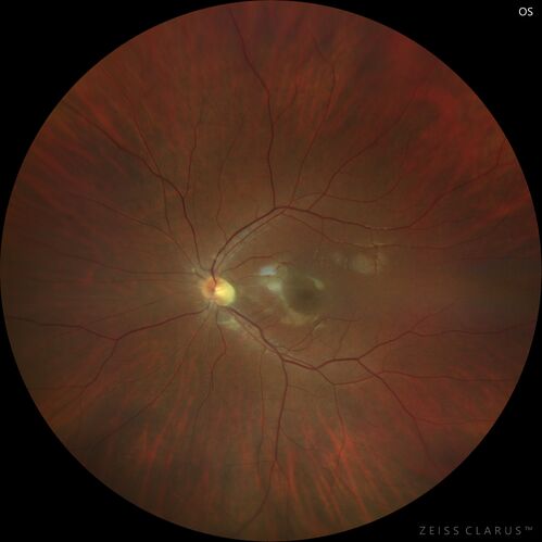Achromatopsia
28 year old female Good vision since birth started wearing glasses at 2, denies trauma. She does have congenital nystagmus.

VA OD: Dcc20/200-2 PH20/200 NccJ7
VA OS: Dcc20/160 PHNI NccJ7
IOP: TP: OD:15 OS:12
