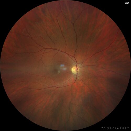 Achromatopsia
28 year old female Good vision since birth started wearing glasses at 2, denies trauma. She does have congenital nystagmus.

VA OD: Dcc20/200-2 PH20/200 NccJ7
VA OS: Dcc20/160 PHNI NccJ7
IOP: TP: OD:15 OS:12
