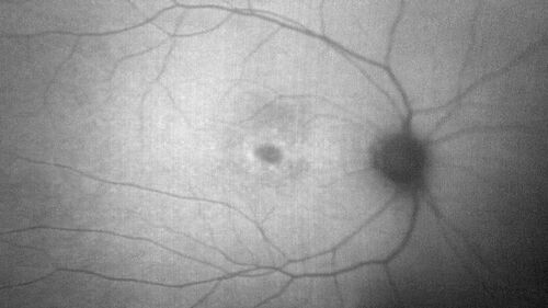 Achromatopsia
28 year old female Good vision since birth started wearing glasses at 2, denies trauma. She does have congenital nystagmus.

VA OD: Dcc20/200-2 PH20/200 NccJ7
VA OS: Dcc20/160 PHNI NccJ7
IOP: TP: OD:15 OS:12
