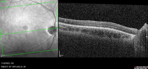 Achromatopsia
28 year old female Good vision since birth started wearing glasses at 2, denies trauma. She does have congenital nystagmus.

VA OD: Dcc20/200-2 PH20/200 NccJ7
VA OS: Dcc20/160 PHNI NccJ7
IOP: TP: OD:15 OS:12
