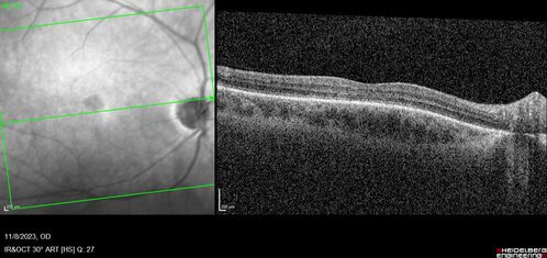 Achromatopsia
28 year old female Good vision since birth started wearing glasses at 2, denies trauma. She does have congenital nystagmus.

VA OD: Dcc20/200-2 PH20/200 NccJ7
VA OS: Dcc20/160 PHNI NccJ7
IOP: TP: OD:15 OS:12
