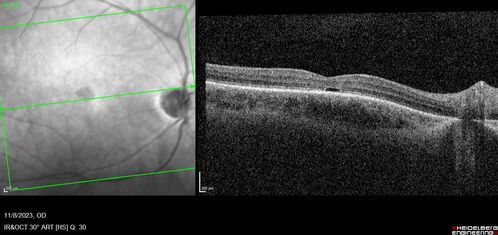 Achromatopsia
28 year old female Good vision since birth started wearing glasses at 2, denies trauma. She does have congenital nystagmus.

VA OD: Dcc20/200-2 PH20/200 NccJ7
VA OS: Dcc20/160 PHNI NccJ7
IOP: TP: OD:15 OS:12

