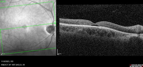Achromatopsia
28 year old female Good vision since birth started wearing glasses at 2, denies trauma. She does have congenital nystagmus.

VA OD: Dcc20/200-2 PH20/200 NccJ7
VA OS: Dcc20/160 PHNI NccJ7
IOP: TP: OD:15 OS:12
