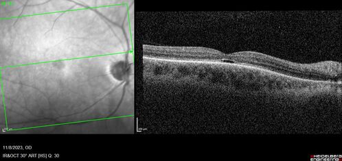 Achromatopsia
28 year old female Good vision since birth started wearing glasses at 2, denies trauma. She does have congenital nystagmus.

VA OD: Dcc20/200-2 PH20/200 NccJ7
VA OS: Dcc20/160 PHNI NccJ7
IOP: TP: OD:15 OS:12
