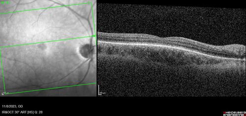 Achromatopsia
28 year old female Good vision since birth started wearing glasses at 2, denies trauma. She does have congenital nystagmus.

VA OD: Dcc20/200-2 PH20/200 NccJ7
VA OS: Dcc20/160 PHNI NccJ7
IOP: TP: OD:15 OS:12
