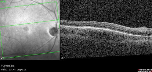 Achromatopsia
28 year old female Good vision since birth started wearing glasses at 2, denies trauma. She does have congenital nystagmus.

VA OD: Dcc20/200-2 PH20/200 NccJ7
VA OS: Dcc20/160 PHNI NccJ7
IOP: TP: OD:15 OS:12

