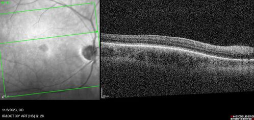 Achromatopsia
28 year old female Good vision since birth started wearing glasses at 2, denies trauma. She does have congenital nystagmus.

VA OD: Dcc20/200-2 PH20/200 NccJ7
VA OS: Dcc20/160 PHNI NccJ7
IOP: TP: OD:15 OS:12
