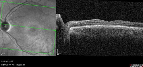 Achromatopsia
28 year old female Good vision since birth started wearing glasses at 2, denies trauma. She does have congenital nystagmus.

VA OD: Dcc20/200-2 PH20/200 NccJ7
VA OS: Dcc20/160 PHNI NccJ7
IOP: TP: OD:15 OS:12
