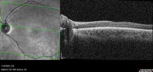 Achromatopsia
28 year old female Good vision since birth started wearing glasses at 2, denies trauma. She does have congenital nystagmus.

VA OD: Dcc20/200-2 PH20/200 NccJ7
VA OS: Dcc20/160 PHNI NccJ7
IOP: TP: OD:15 OS:12
