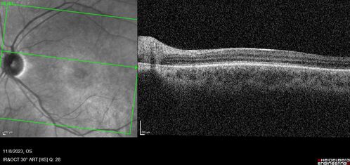 Achromatopsia
28 year old female Good vision since birth started wearing glasses at 2, denies trauma. She does have congenital nystagmus.

VA OD: Dcc20/200-2 PH20/200 NccJ7
VA OS: Dcc20/160 PHNI NccJ7
IOP: TP: OD:15 OS:12

