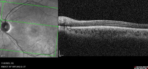 Achromatopsia
28 year old female Good vision since birth started wearing glasses at 2, denies trauma. She does have congenital nystagmus.

VA OD: Dcc20/200-2 PH20/200 NccJ7
VA OS: Dcc20/160 PHNI NccJ7
IOP: TP: OD:15 OS:12
