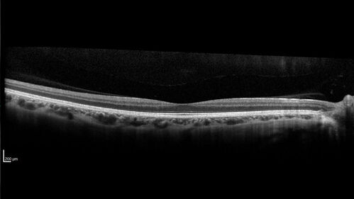 Autosomal Dominant Optic Atrophy - OPA1 Mutation
25 year old  female with VA 20/80 OU and recent vision decline.  Her father also has poor vision.
