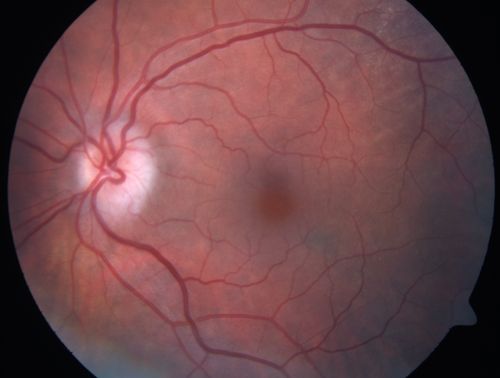 Acute non arteritic anterior ischemic optic neuropathy left eye - Color Photo
66 y.o. woman spot in central vision in left eye started about 1 week ago since then it is not changing. VA OD: sc20/25 OS: sc20/200 
