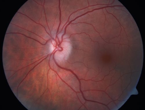Acute non arteritic anterior ischemic optic neuropathy left eye - Color Photo
66 y.o. woman spot in central vision in left eye started about 1 week ago since then it is not changing. VA OD: sc20/25 OS: sc20/200 

