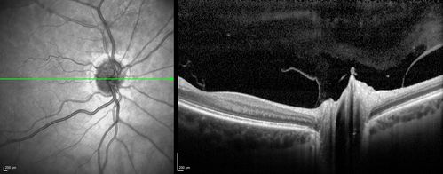 Acute non arteritic anterior ischemic optic neuropathy left eye - SD Optical Coherence Tomography Line Scan
66 y.o. woman spot in central vision in left eye started about 1 week ago since then it is not changing. VA OD: sc20/25 OS: sc20/200 

