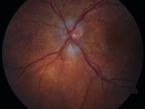Non-arteritic Anterior Ischemic Optic Neuropathy following Intravitreal Injection 
81-year-old woman has had injections in both eyes for wet age-related macular degeneration.  2 weeks ago the left eye was treated. Less than a week ago she noticed a change in vision in the left eye.  She had a dull left frontal headache and noticed her vision was hazy as if there was a veil over the vision. OD is 20/25, OS is 20/25.  IOP:  OD 18, OS 26.  The left eye has a 3+ APD
