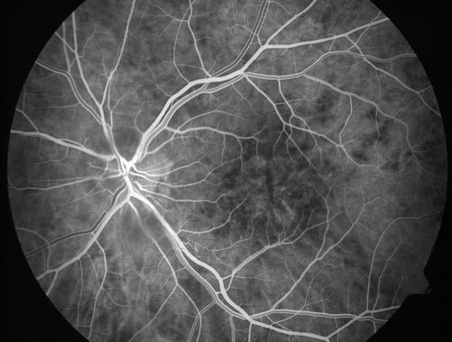 Non-arteritic Anterior Ischemic Optic Neuropathy following Intravitreal Injection 
81-year-old woman has had injections in both eyes for wet age-related macular degeneration.  2 weeks ago the left eye was treated. Less than a week ago she noticed a change in vision in the left eye.  She had a dull left frontal headache and noticed her vision was hazy as if there was a veil over the vision. OD is 20/25, OS is 20/25.  IOP:  OD 18, OS 26.  The left eye has a 3+ APD
