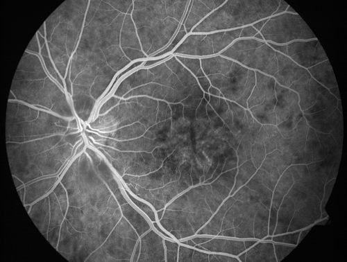 Non-arteritic Anterior Ischemic Optic Neuropathy following Intravitreal Injection 
81-year-old woman has had injections in both eyes for wet age-related macular degeneration.  2 weeks ago the left eye was treated. Less than a week ago she noticed a change in vision in the left eye.  She had a dull left frontal headache and noticed her vision was hazy as if there was a veil over the vision. OD is 20/25, OS is 20/25.  IOP:  OD 18, OS 26.  The left eye has a 3+ APD
