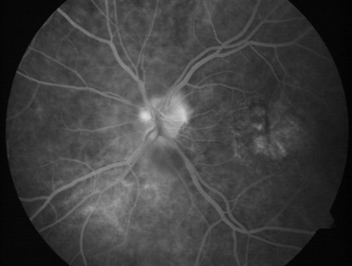 Non-arteritic Anterior Ischemic Optic Neuropathy following Intravitreal Injection 
81-year-old woman has had injections in both eyes for wet age-related macular degeneration.  2 weeks ago the left eye was treated. Less than a week ago she noticed a change in vision in the left eye.  She had a dull left frontal headache and noticed her vision was hazy as if there was a veil over the vision. OD is 20/25, OS is 20/25.  IOP:  OD 18, OS 26.  The left eye has a 3+ APD
