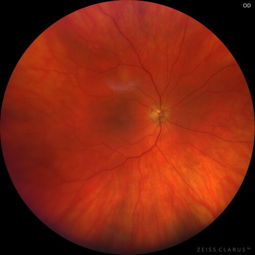 Oculocutaneous albinism
62 year old female.  Testing shows an absence of a fovea.  Vision was 20/50 and she has nystagmus.
