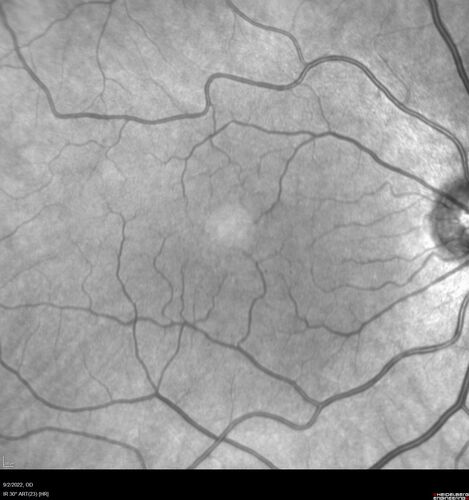 Oculocutaneous albinism
62 year old female.  Testing shows an absence of a fovea.  Vision was 20/50 and she has nystagmus.
