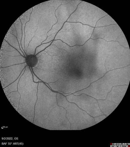 Oculocutaneous albinism
62 year old female.  Testing shows an absence of a fovea.  Vision was 20/50 and she has nystagmus.
